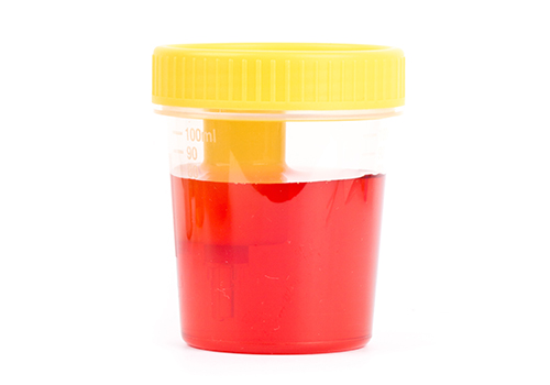bloody urine