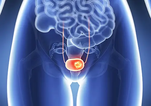 xray of bladder